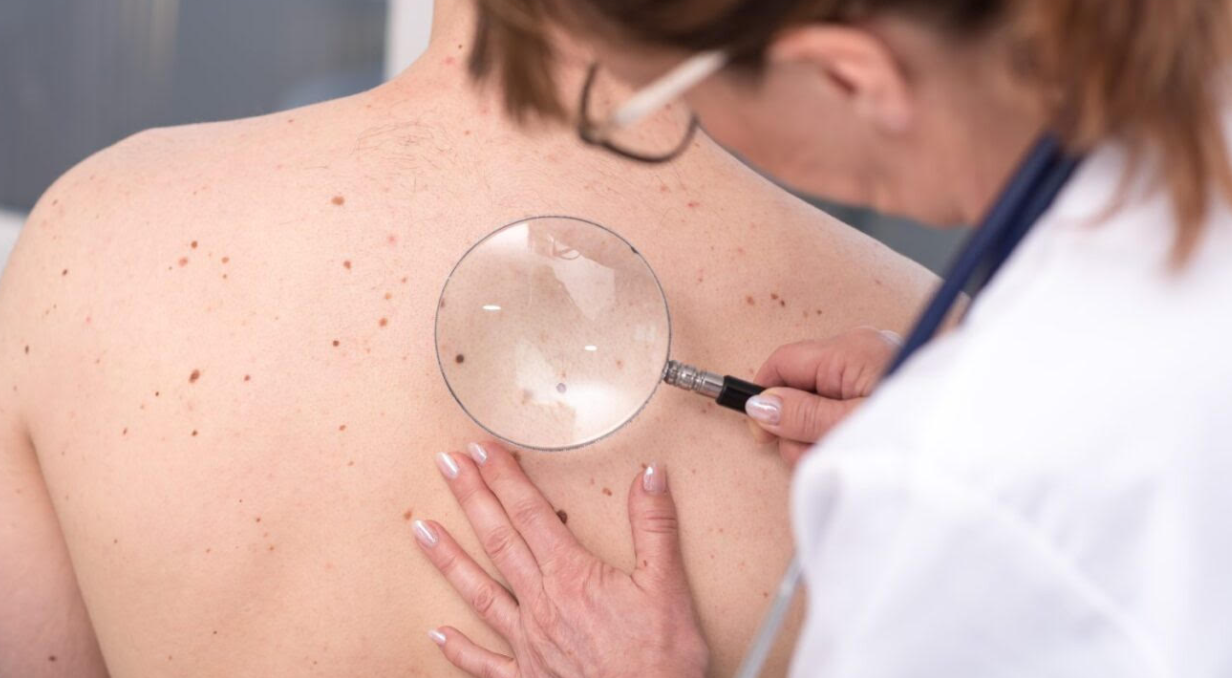 Operativo de chequeo de lunares gratuito llega a Reñaca para detectar y prevenir el cáncer a la piel