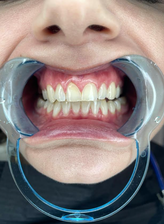 En el Mes Mundial de la Salud Gingival: advierten sobre el impacto de las encías en la salud integral y entregan claves para su cuidado